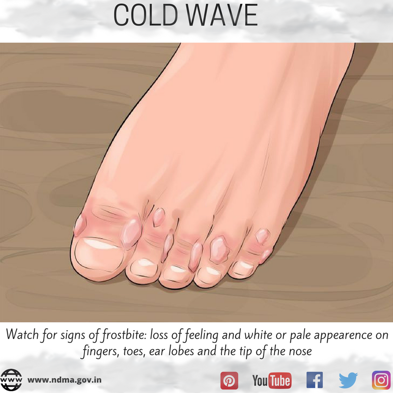 Watch for signs of frostbite, loss of feeling and white or pale appearance on fingers, toes, earlobes and the tip of the nose.